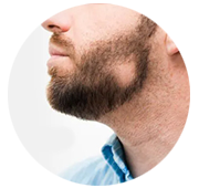 Alopecia Treatment - Hair & Beard