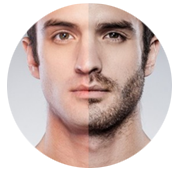 Beard Transplantation