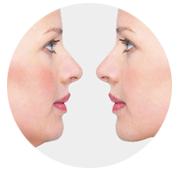 Double Chin Correction