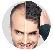 Hair Transplantation